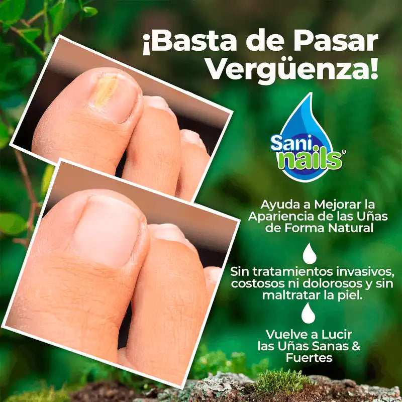 SaniNails Ayuda a Combatir Los Hongos de Tus Uñas